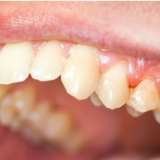 What Are Common Signs Of Gum Disease And What Should You Do About It